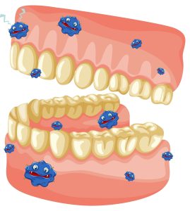 gingivită