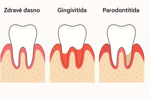 gingivită